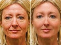 St Mellion Cosmetic Clinic 378150 Image 4